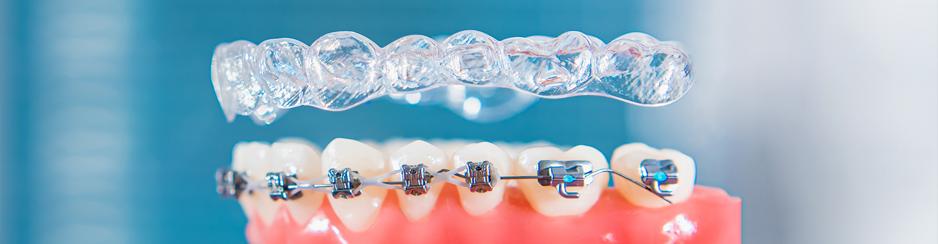 clear aligner floating above lower jaw model with braces on teeth